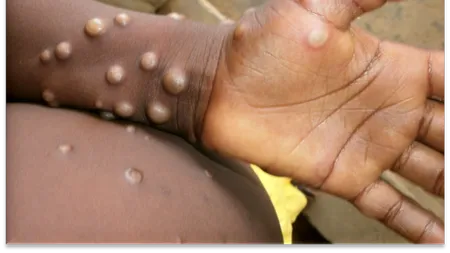 Noi cazuri de „variola maimuțelor”, depistate în Marea Britanie. Simptomele bolii