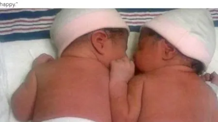 S-au născut ținându-se de mână. Imaginile care au impresionat o lume întreagă