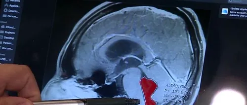 Un bărbat care a suferit dureri de cap ani de zile a descoperit că avea viermi care trăiau în creierul lui