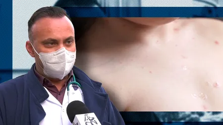 EXCLUSIV VIDEO | Epidemia de rujeolă în România. Director medical „Matei Balș”: Nu reușim să ajungem la un echilibru în ceea ce privește vaccinarea