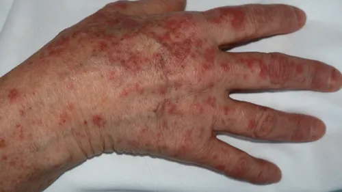 Iritații neobișnuite și „degetul covid”, noi simptome care îi șochează pe medici manifestate de pacienții diagnosticați cu noul coronavirus - FOTO