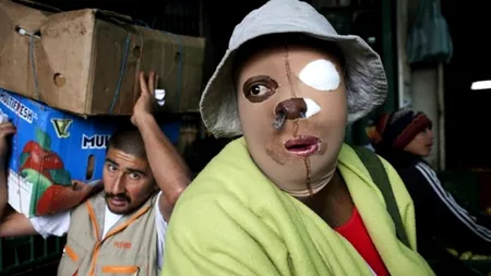 DRAMA femeilor desfigurate cu acid: 