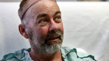 Premieră în lumea medicală. Primul transplant de craniu și de scalp a fost făcut în Statele Unite