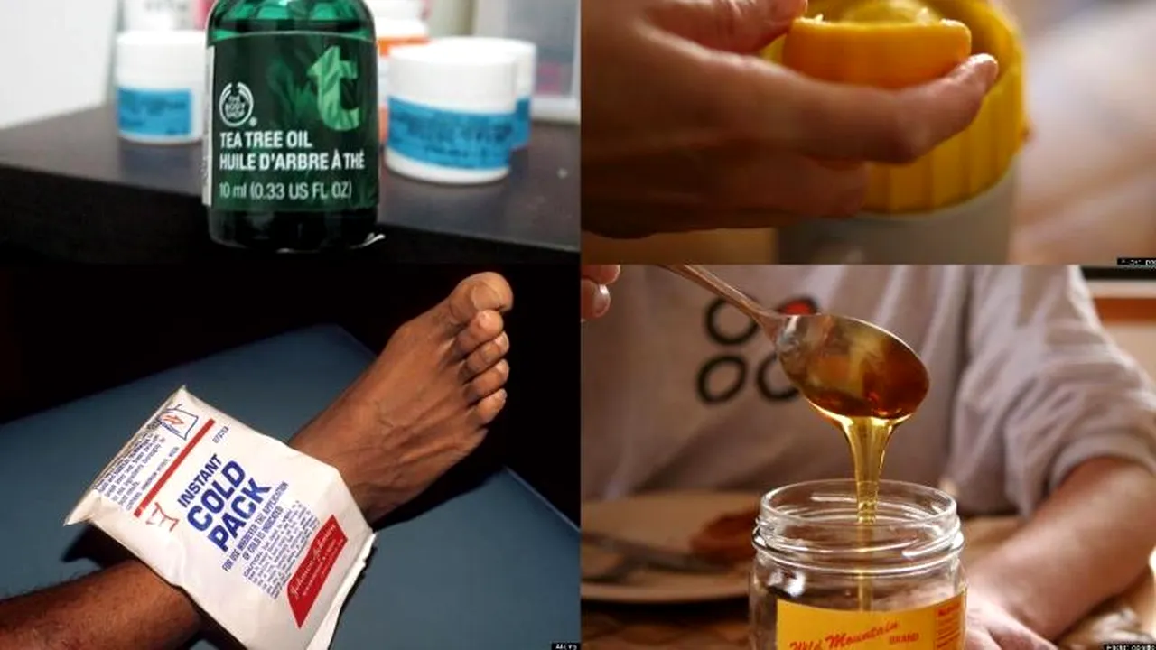 Lista metodelor naturale de a trata ciupiturile de țânțari