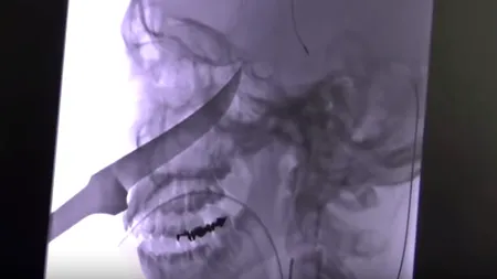 Noroc chior. Un adolescent a ajuns la spital cu o lamă de cuțit înfiptă în față. Mama băiatului: Este aproape un miracol - VIDEO