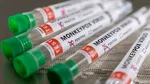 Doi cercetători ai Institutului Național de Sănătate din SUA, acuzați că au introdus ilegal probe cu virusul variola maimuței în țară