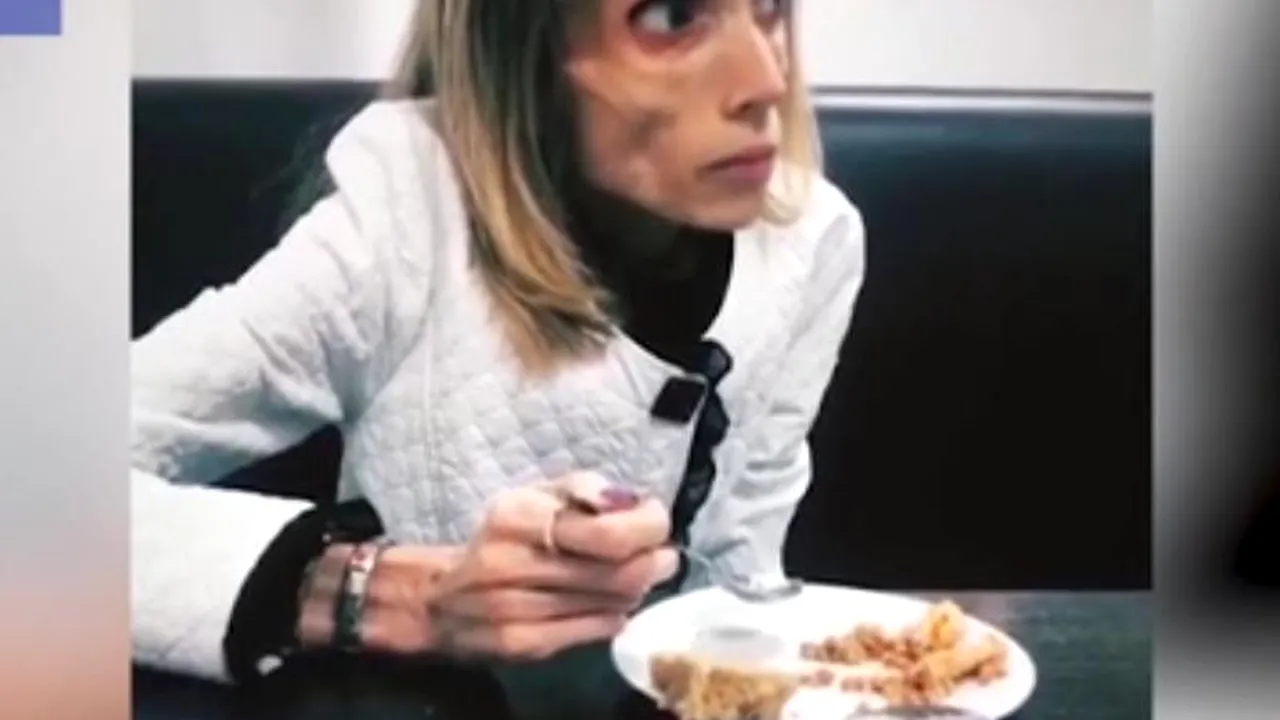 CAZ EXTREM de ANOREXIE. La 26 de ani, o tânără cântărește 17 KILOGRAME. Medicii sunt categorici: Poți juca lejer rolul unui CADAVRU într-un film horror!