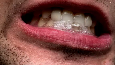 Semnul neobișnuit al diabetului indicat de SALIVĂ. Boli pe care le poți depista observând scuipatul