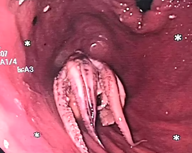 Descoperirea șocantă făcută de medici în esofagul unui pacient / Sursa foto: Clinical Gastroenterology and Hepatology