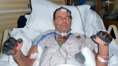 Caz de CIUMĂ BUBONICĂ în SUA. Cum a reușit un american să supraviețuiască bolii