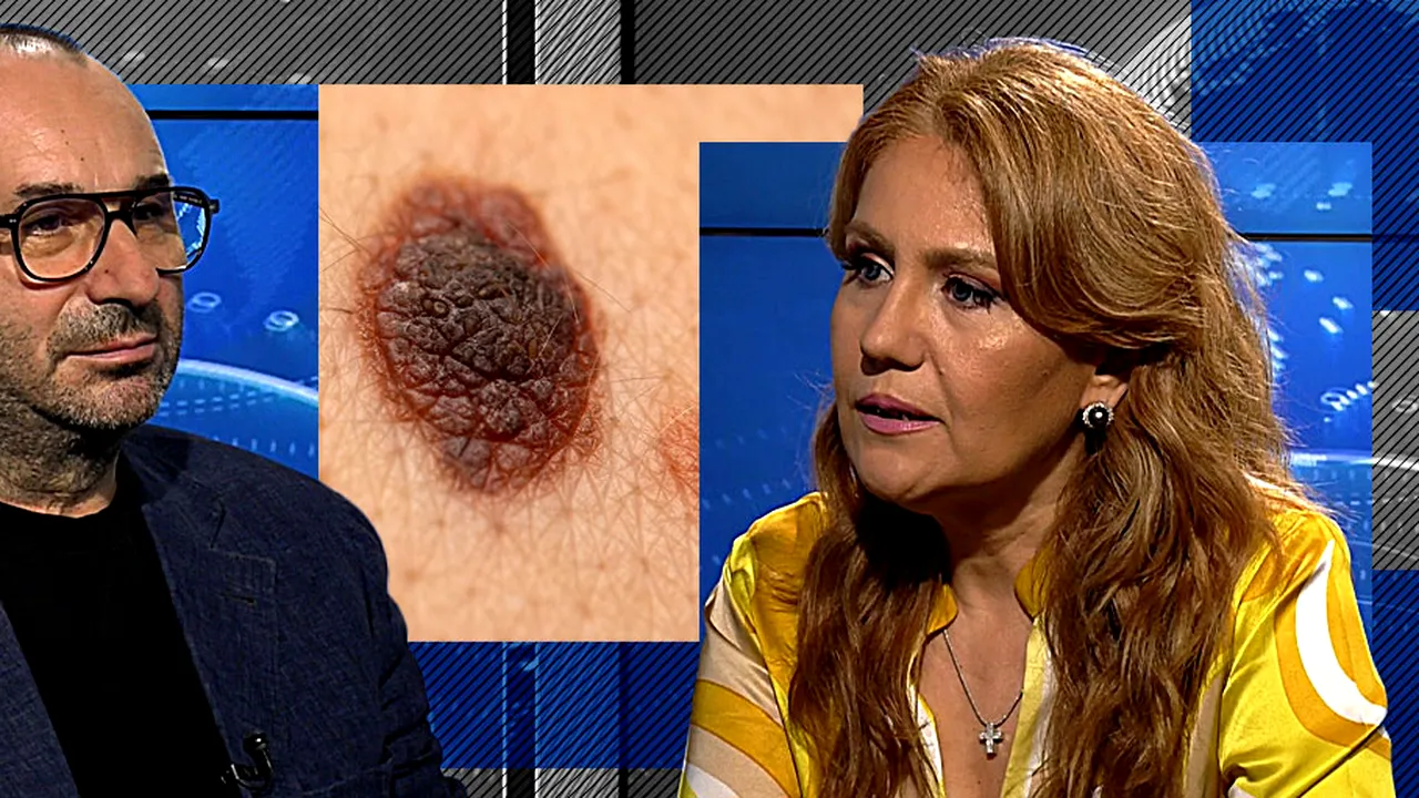 Prof. univ. dr. Olga Simionescu: „Melanomul este mult mai grav decât alte tipuri de cancer”