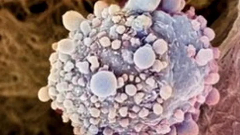 STUDIU. S-a descoperit gena eficientă împotriva cancerului de pancreas