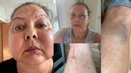 Calvarul româncei care s-a îmbolnăvit după VACCINUL anti-COVID și se luptă cu Pfizer-BioNTech. ”Seara îmi dezumflau capul, dimineața se umfla iar”