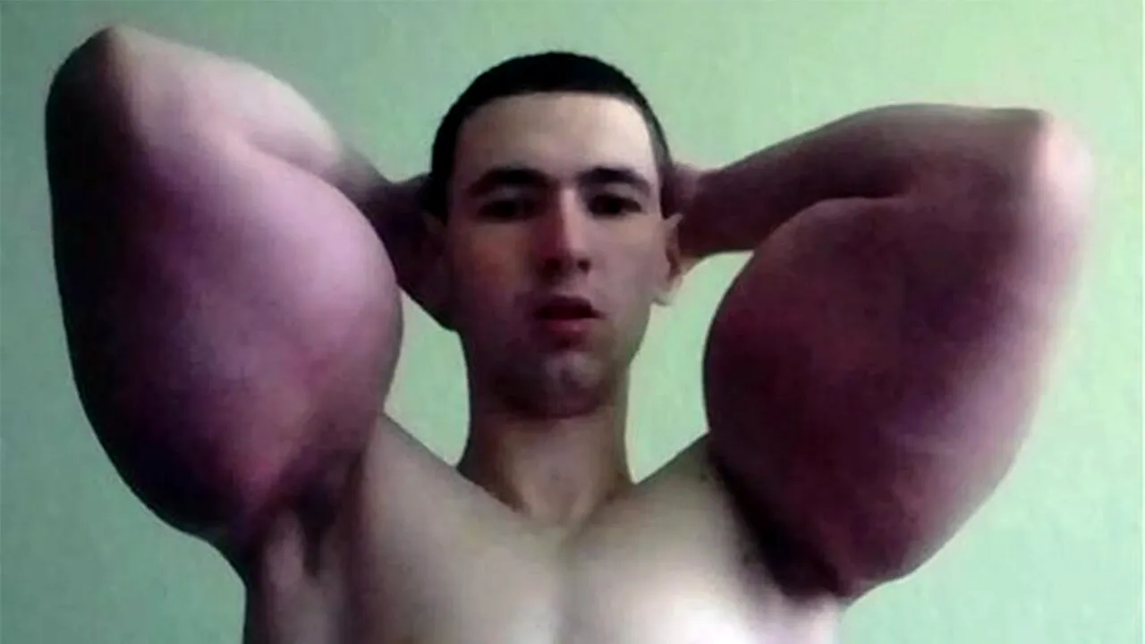 Ireal cum a ajuns să arate tânărul din imagine, după ce și-a injectat ulei în bicepși