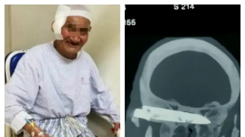 ULUITOR. Un bărbat a trăit 26 de ani cu un cuțit în cap: Nu puteam să râd, să casc sau să tușesc. Doctorii mi-au dat o nouă șansă la viață