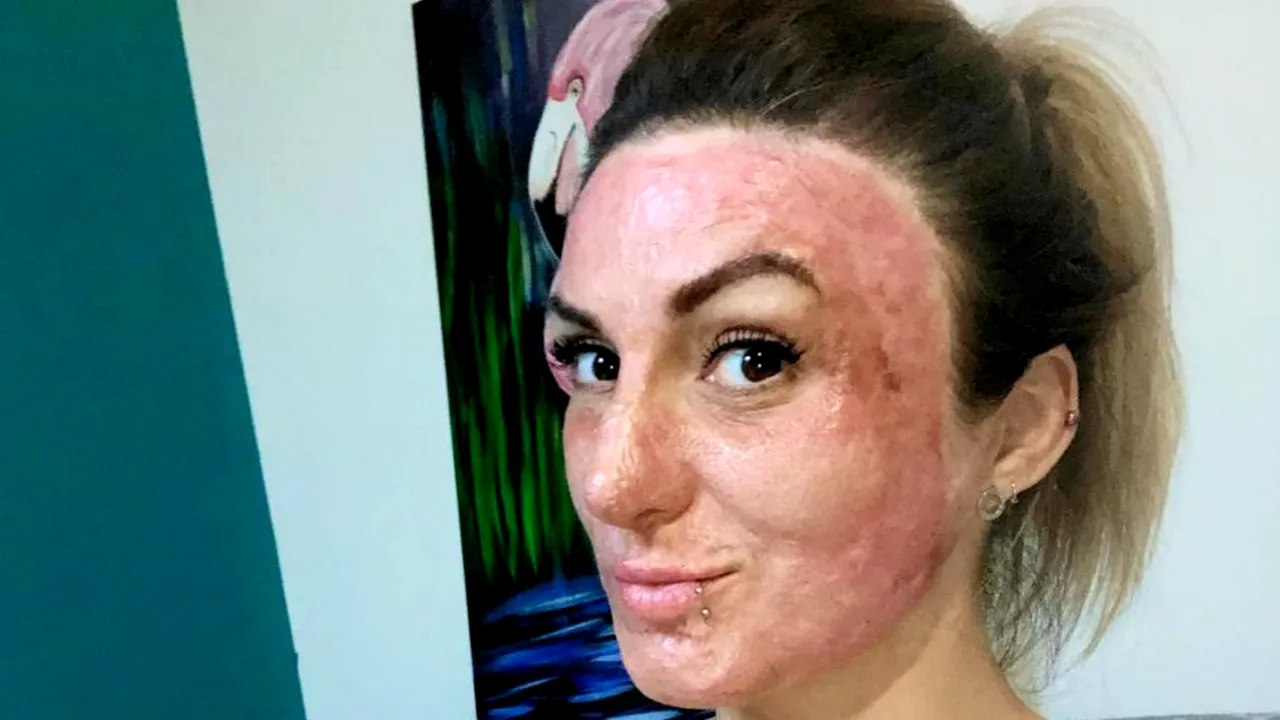 5 ani de la Colectiv. Povestea unei supraviețuitoare care a ajuns în Belgia cu nouă infecții nosocomiale: „Era ca într-un film cu zombie. Oamenii erau negri ca tăciunele” (EXCLUSIV)