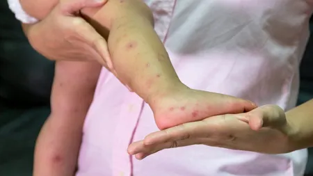 Răspândirea rujeolei: Încă 50 de cazuri au fost confirmate în ultima săptămână în 5 județe