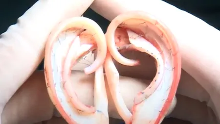 Premieră medicală. Cum i-au „salvat