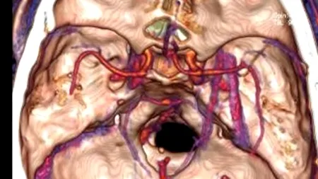 Avea dureri de cap frecvente, dar habar nu avea cu ce trăise în creier atâția ani - FOTO 