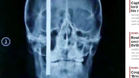 A supraviețuit după ce o bară de oțel i-a intrat 20 de centimetri în cap