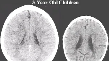 FOTOGRAFIA care dovedește de ce e importantă AFECȚIUNEA pentru dezvoltarea unui copil