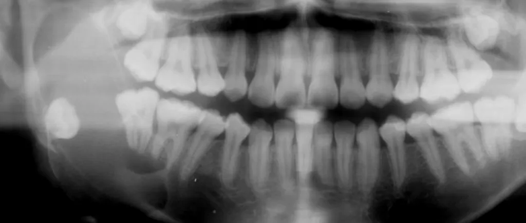 Cât de sigure sunt radiografiile dentare