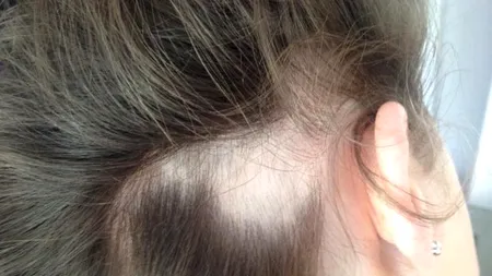 O femeie din Anglia și-a pierdut părul după ce s-a infectat cu COVID-19. “A căzut în grămezi mari, a fost îngrozitor!”