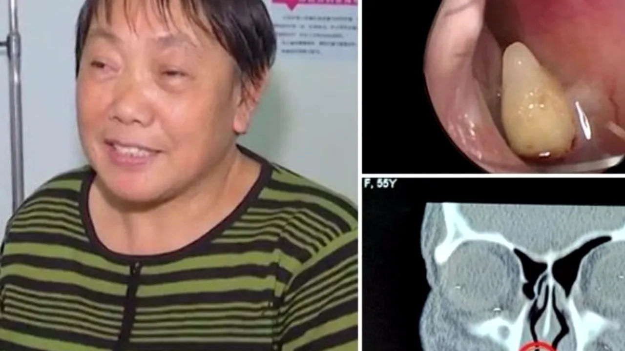 O femeie a avut simptome de răceală timp de mai multe decenii. Când a ajuns la spital, medicii au făcut o descoperire bizară