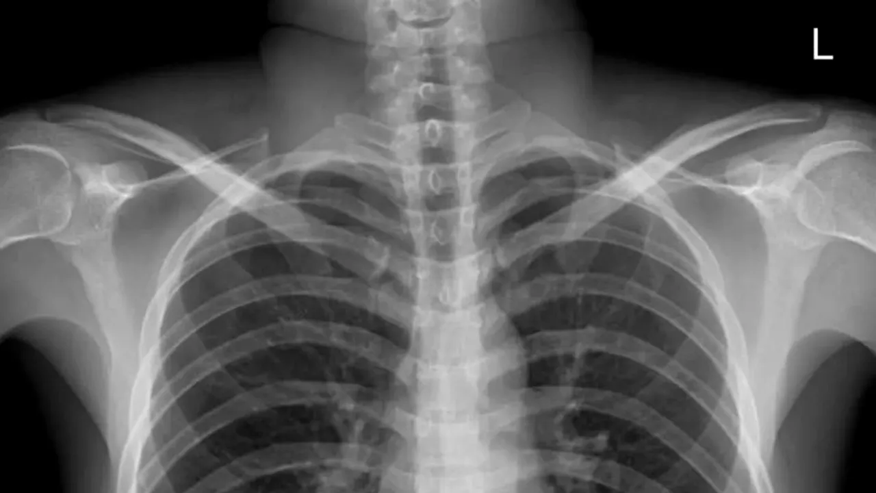 Beție la nivel înalt: S-a trezit cu o durere de stomac, dar când a ajuns la spital medicii i-au găsit un obiect pe care bărbatul îl credea pierdut - FOTO