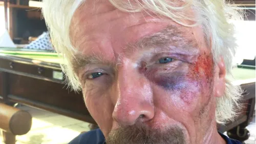 Miliardarul Richard Branson, rănit grav în urma unui accident de bicicletă în Insulele Virgine Britanice. ”Ne-am izbit capetele și corpurile de drumul de beton”