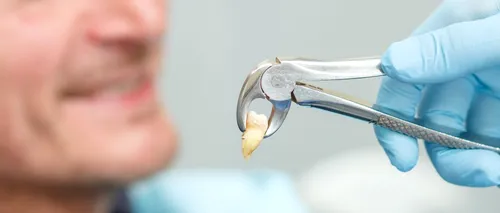 Extracția dinților: cum să te pregătești pentru procedură