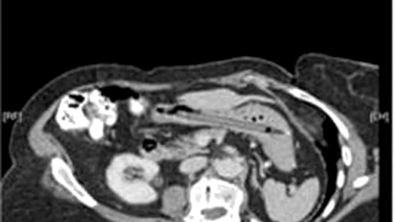 De pe Internet adunate: Lucruri uimitoare pe care medicii le-au găsit în stomacurile pacienților