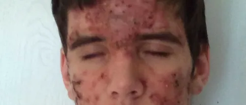 Transformarea unui tânăr desfigurat de acnee