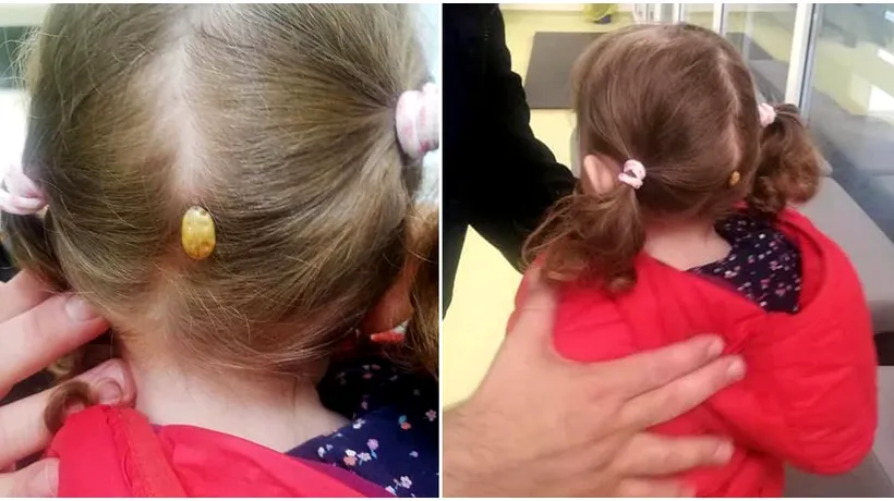 Căpușă uriașă descoperită pe scalpul unei fetițe din Suceava. Copilul a fost dus urgent la spital