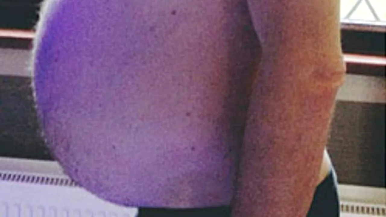 A crezut că s-a îngrășat de la bere, dar medicii i-au dat vestea care i-a schimbat viața