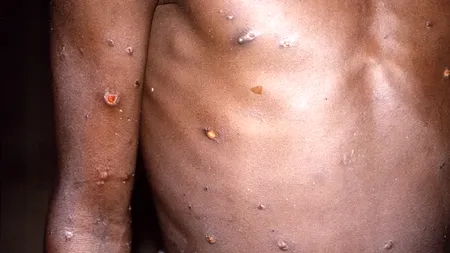 OMS transmite că variola maimuței nu se compară cu COVID-19. Ce soluție are UE pentru această boală