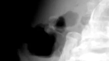 Ce au descoperit medicii în abdomenul unei octogenare care se plângea de dureri