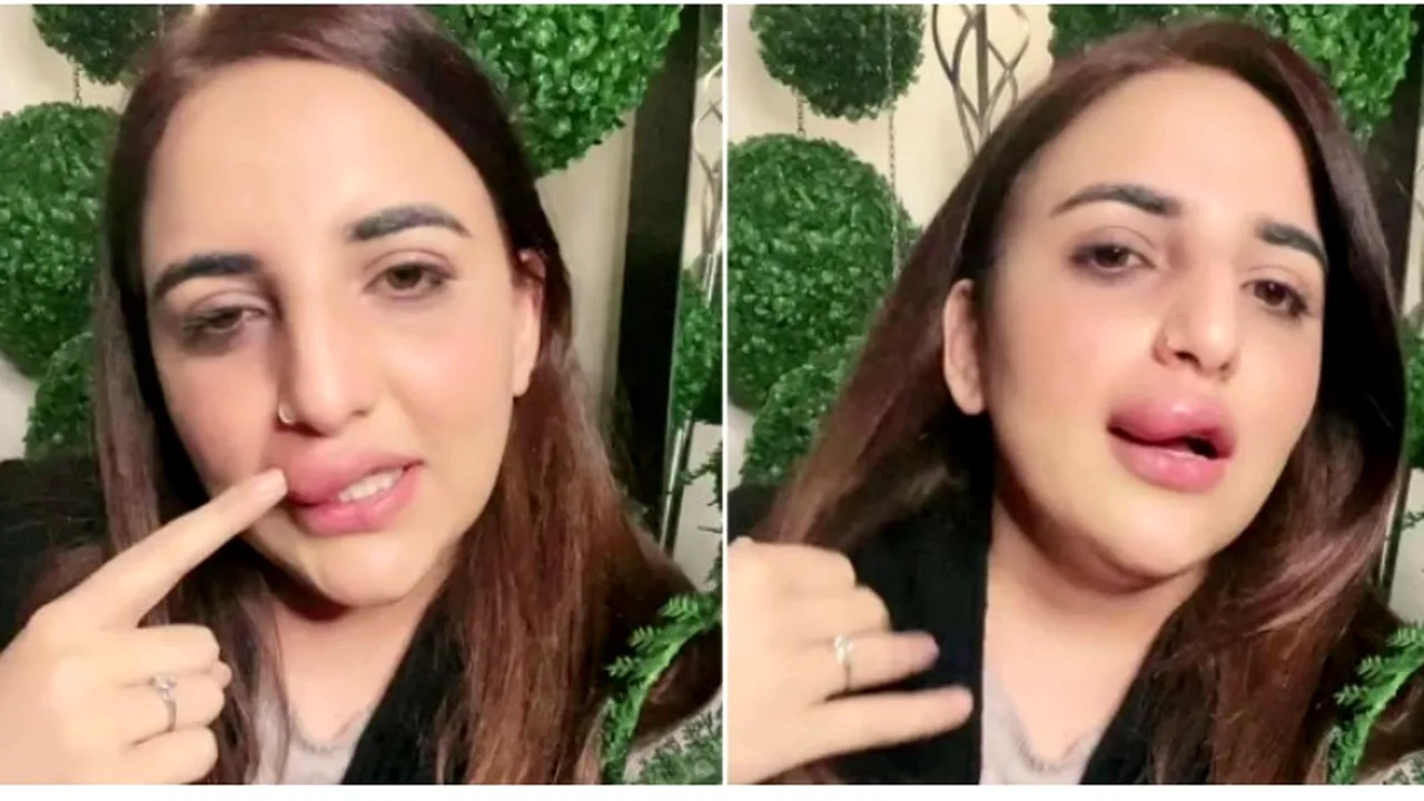 VIDEO | O vedetă de pe TikTok susține că a rămas cu buza umflată, după ce autoritățile i-au înghețat conturile și nu a mai avut bani pentru continuarea intervenției estetice