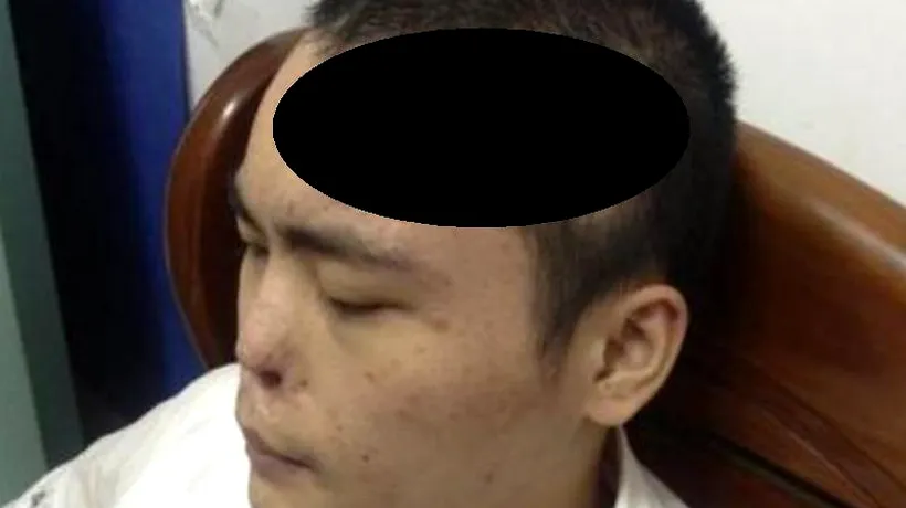 Metoda inedită prin care medicii i-au salvat nasul unui tânăr chinez  