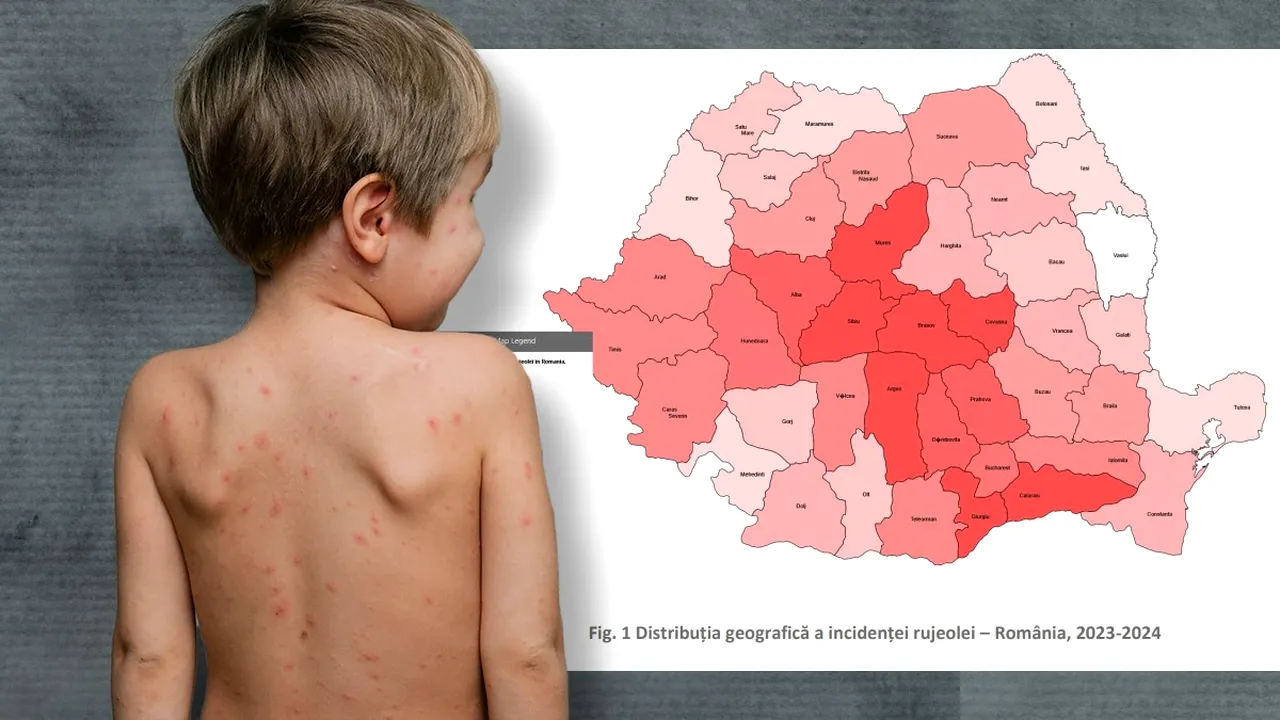 Brașov, în topul rujeolei. Capitala este abia pe locul doi