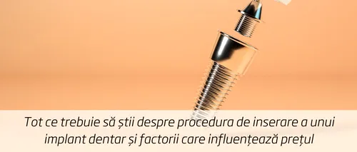 (P) Tot ce trebuie să știi despre procedura de inserare a unui implant dentar și factorii care influențează prețul