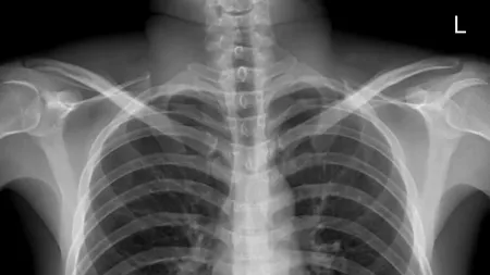 Beție la nivel înalt: S-a trezit cu o durere de stomac, dar când a ajuns la spital medicii i-au găsit un obiect pe care bărbatul îl credea pierdut - FOTO