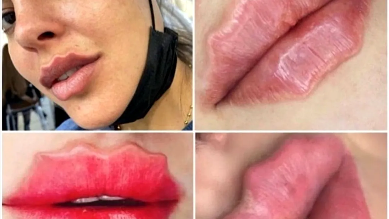 Trendul bizar care le-a înnebunit pe fete. Vor să aibă buze de „caracatiță