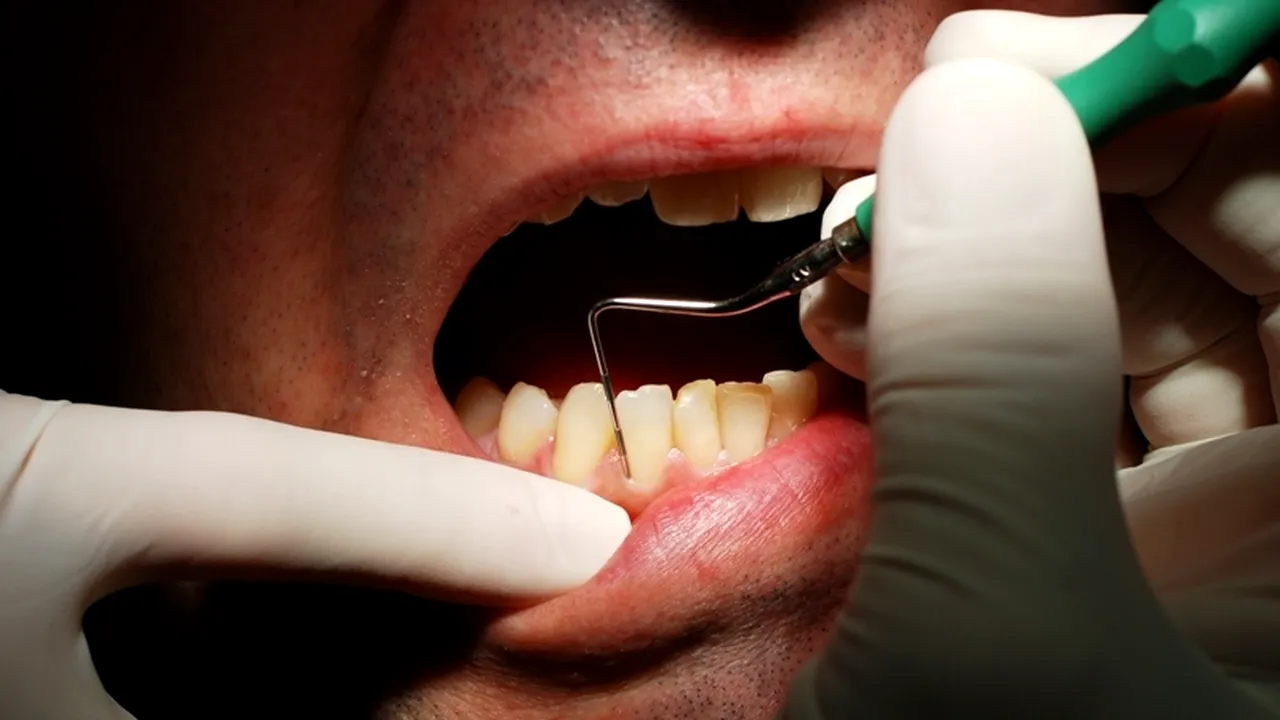 A mers la dentist să-și scoată 20 de dinți. Ce s-a întâmplat pe urmă