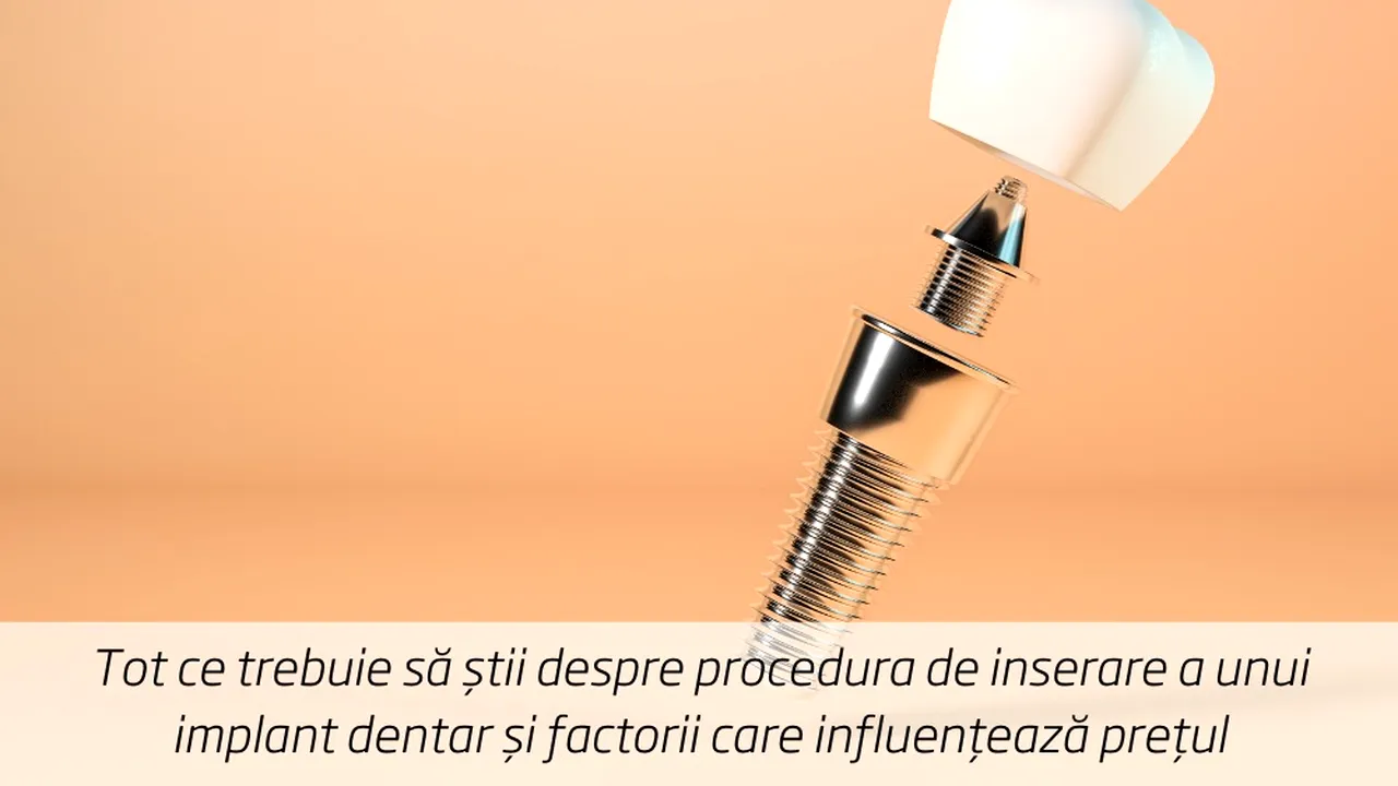 (P) Tot ce trebuie să știi despre procedura de inserare a unui implant dentar și factorii care influențează prețul