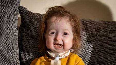 Fetiță de doi ani, singurul pacient din lume care suferă de boala prezentată în filmul „Benjamin Button
