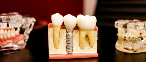 5 motive să-ți faci un implant dentar