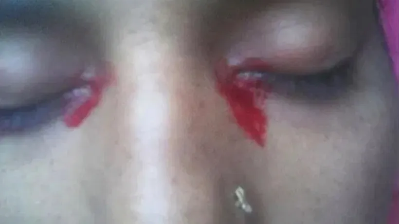 Femeia care plânge lacrimi de sânge: Ce tratament i-au administrat medicii