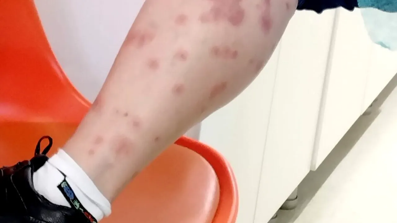 O turistă a fost mușcată de ploșnițe într-un hotel din România. Femeia a ajuns la spital