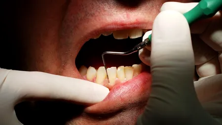 A mers la dentist să-și scoată 20 de dinți. Ce s-a întâmplat pe urmă